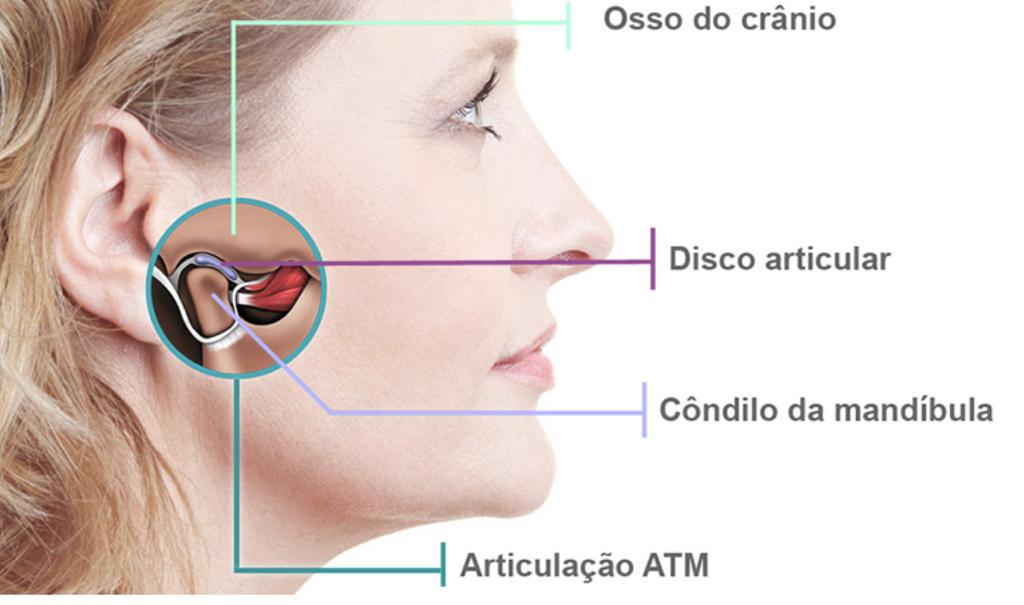 ODONTO MASTER - A articulação temporomandibular (ATM) funciona como uma  dobradiça que liga a mandíbula ao crânio. O bruxismo comumente está  relacionado a disfunção da ATM, ela pode causar dor e desconforto.